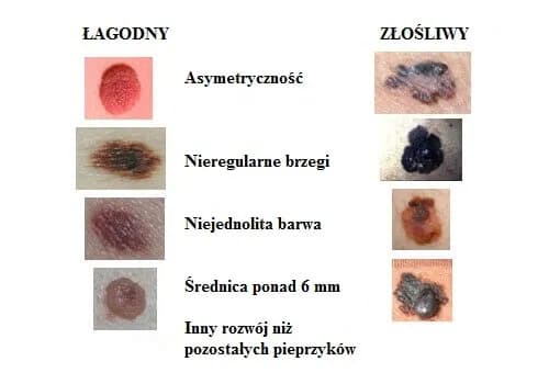 Kto bada pieprzyki? Dermatolog wyjaśnia, kiedy to konieczne i na co uważać Kto bada pieprzyki? Dermatolog wyjaśnia, kiedy to konieczne i na co uważać