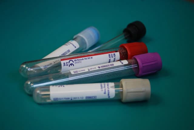Co to jest APTT w badaniu krwi? Normy, przyczyny odchyleń i znaczenie diagnostyczne Co to jest APTT w badaniu krwi? Normy, przyczyny odchyleń i znaczenie diagnostyczne