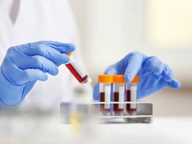 Co to jest ASO w badaniu krwi? Normy, interpretacja i znaczenie diagnostyczne Co to jest ASO w badaniu krwi? Normy, interpretacja i znaczenie diagnostyczne