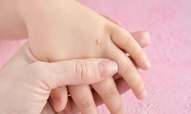 Skąd się biorą kurzajki? Poznaj przyczyny i skutki zakażenia HPV Skąd się biorą kurzajki? Poznaj przyczyny i skutki zakażenia HPV